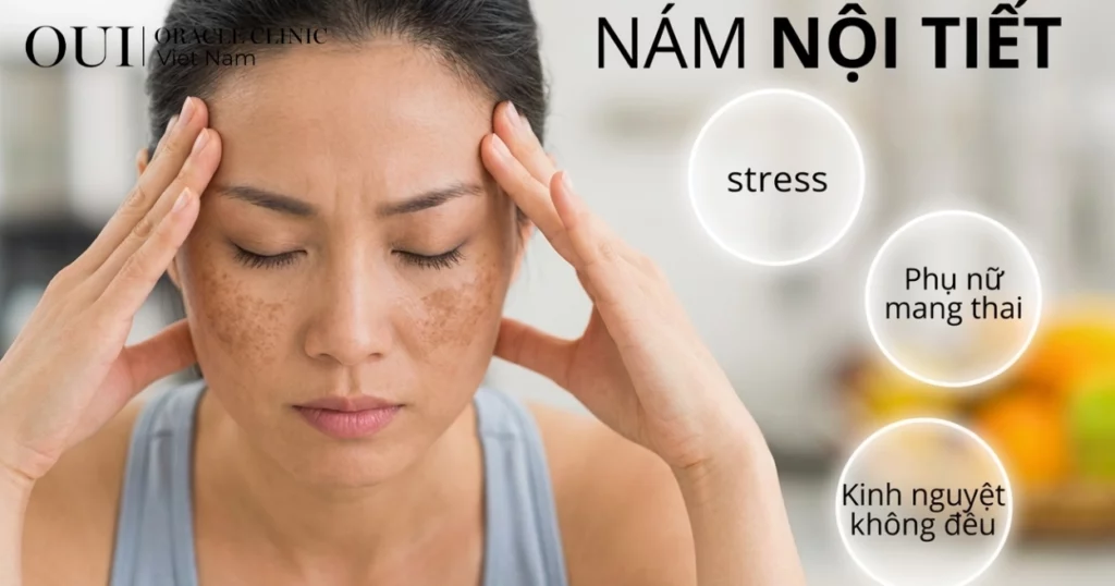 Nám nội tiết có trị hết không?