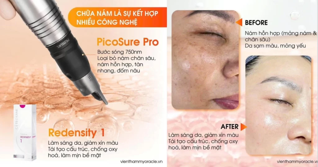Nám nội tiết có trị hết không?