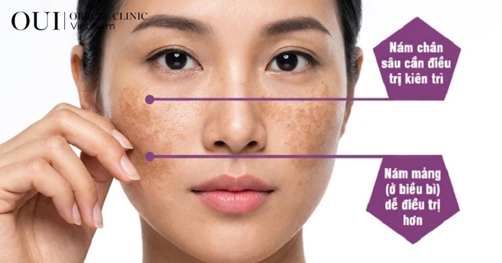 Nám nội tiết có trị hết không?