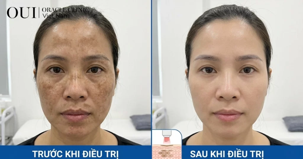 Nám nội tiết có trị hết không?