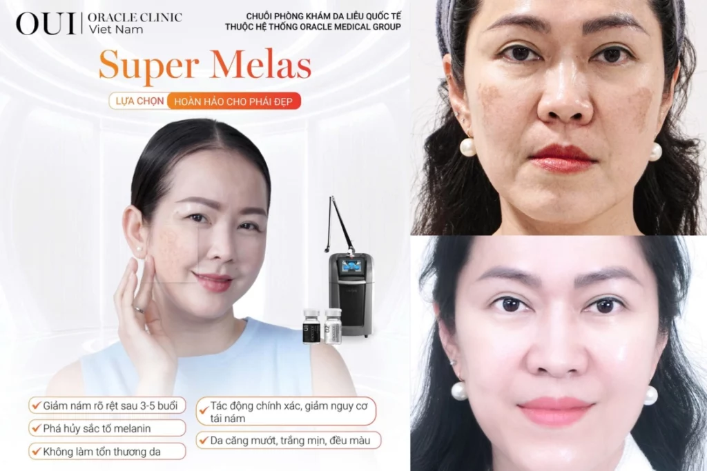 nám sau sinh bao lâu mới hết