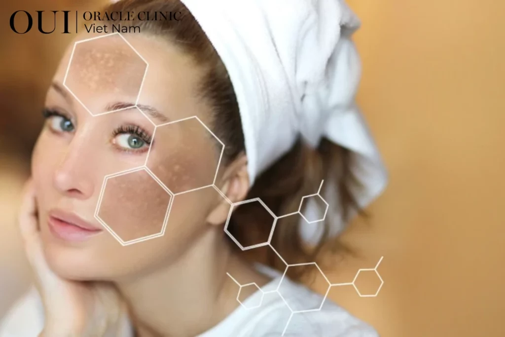 nám sau sinh bao lâu mới hết