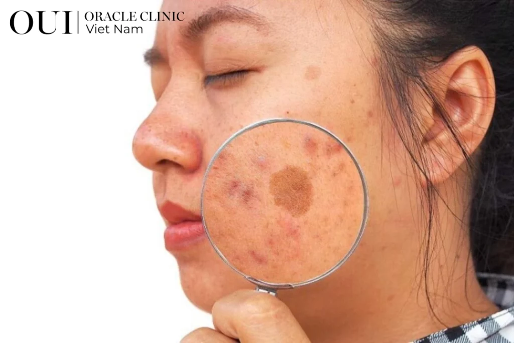 nám sau sinh bao lâu mới hết