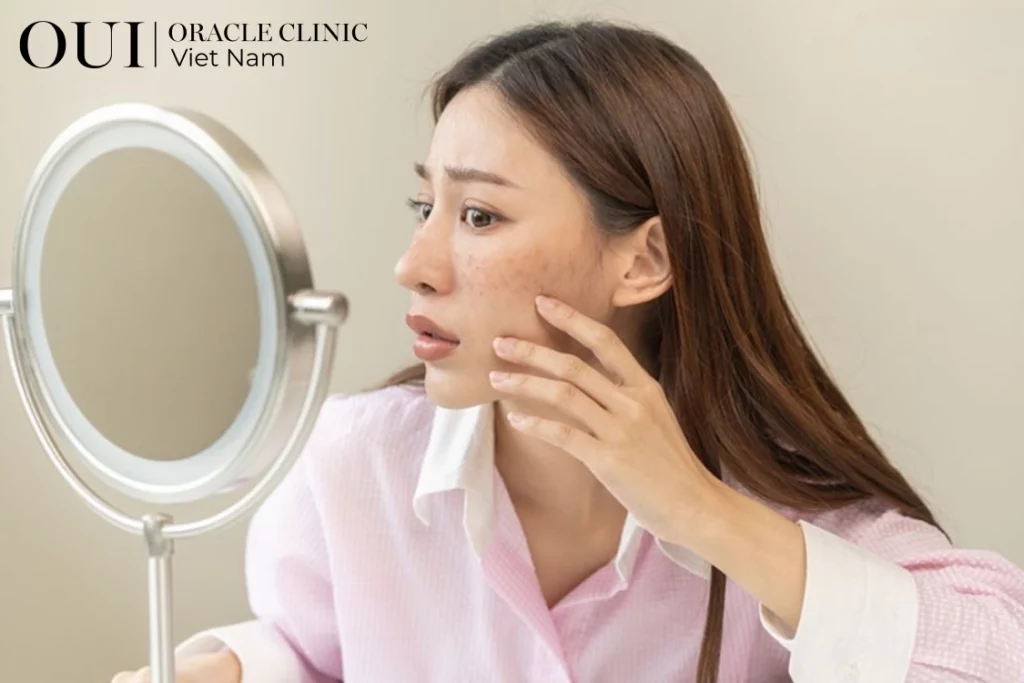 nám sau sinh bao lâu mới hết