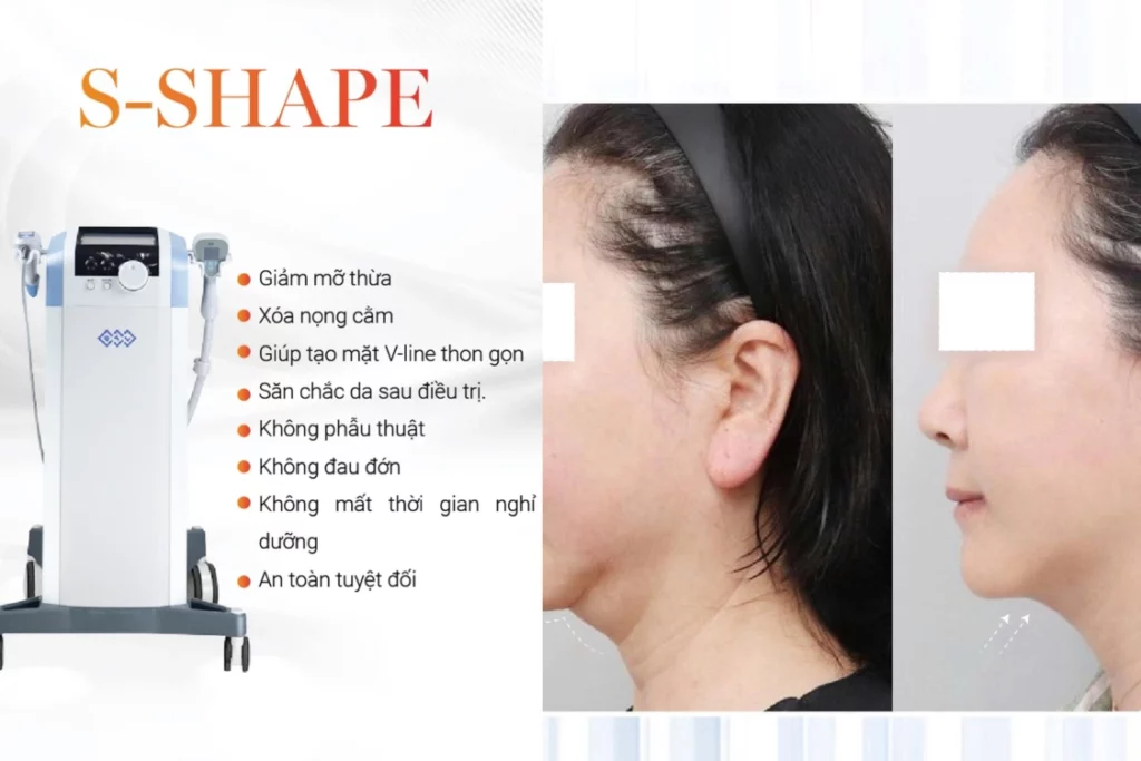 nâng cơ mặt chảy xệ