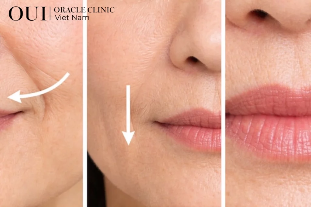 nâng cơ mặt chảy xệ