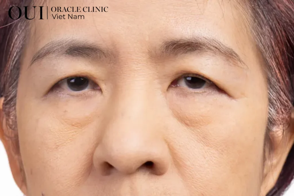 nâng cơ mặt chảy xệ