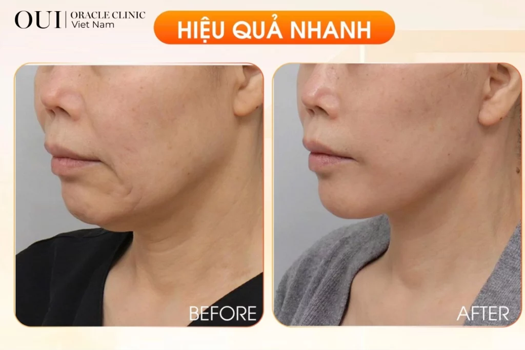 nâng cơ mặt chảy xệ