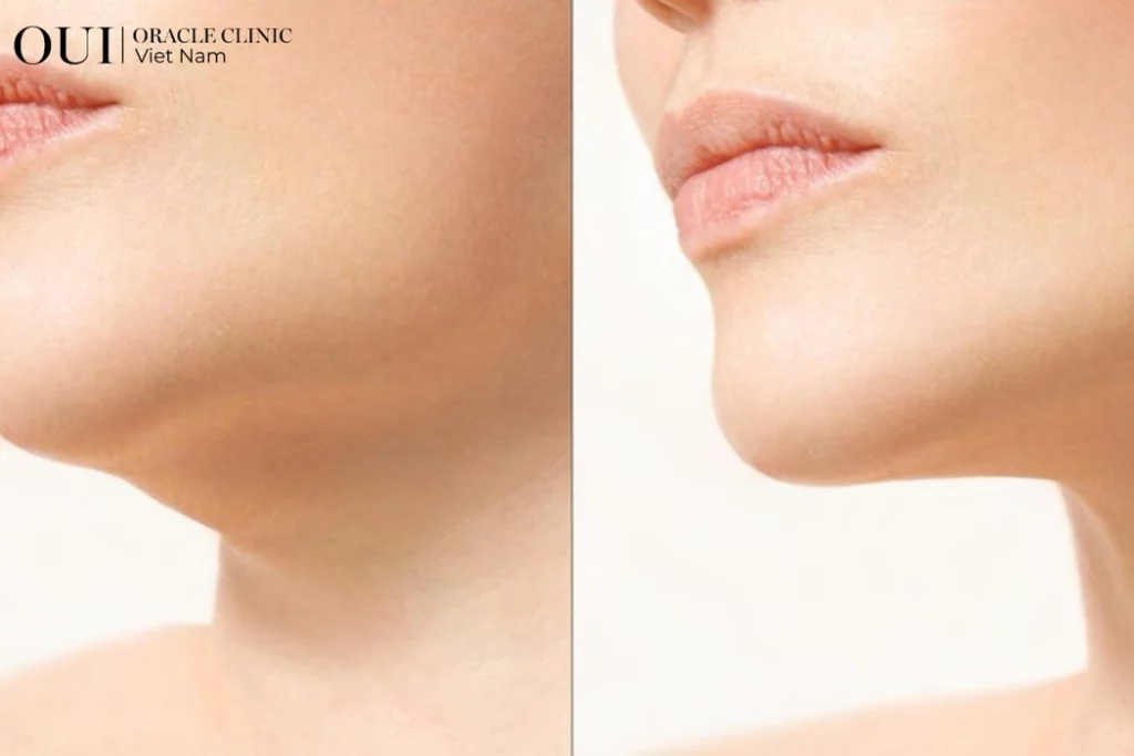 Nâng cơ mặt có trẻ hơn không?