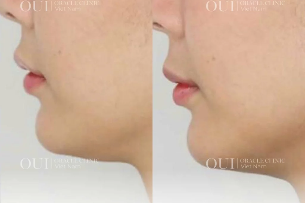 Nâng cơ mặt có trẻ hơn không?