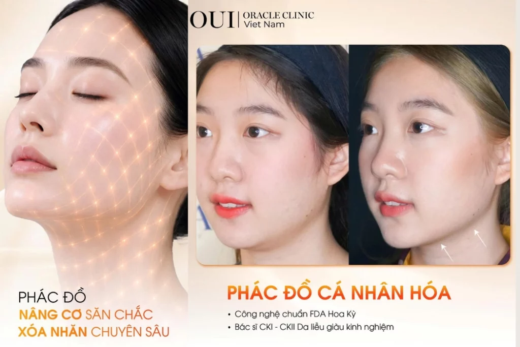 Nâng cơ mặt có trẻ hơn không?