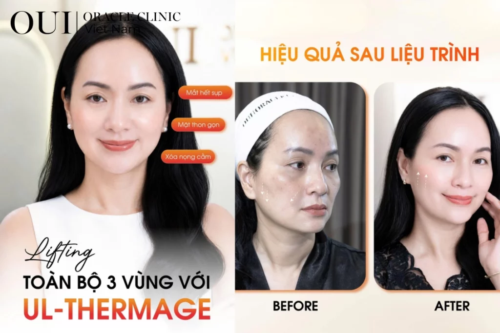 Thermage FLX có cần làm lại không?