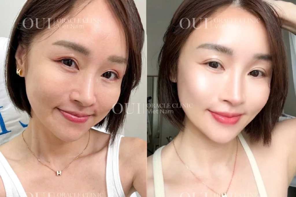 Thermage FLX có cần làm lại không?