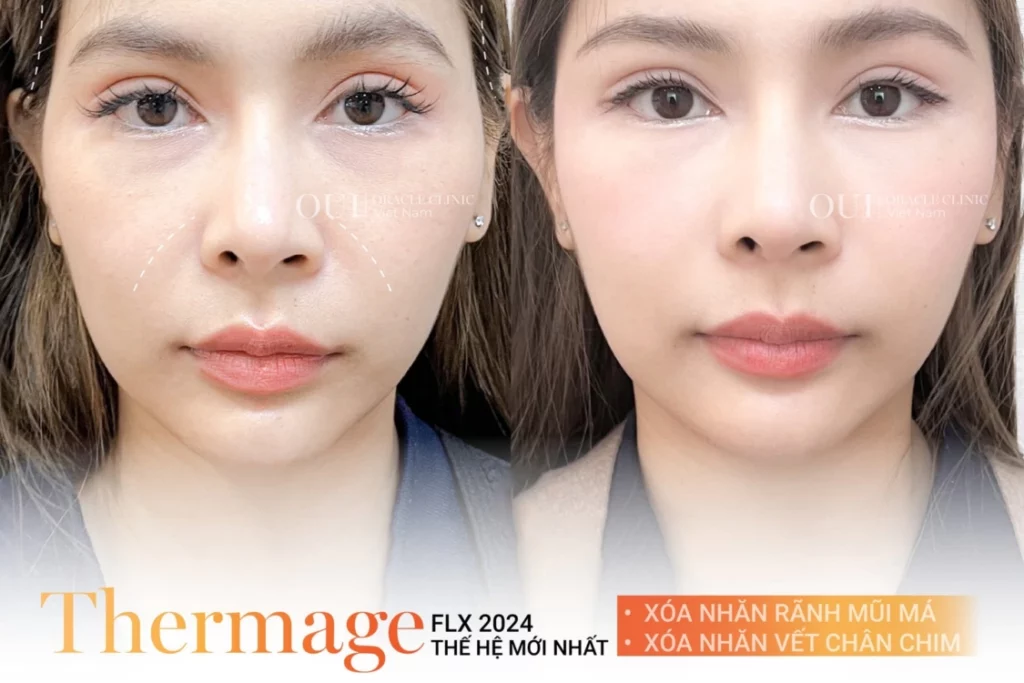 Thermage FLX có cần làm lại không?