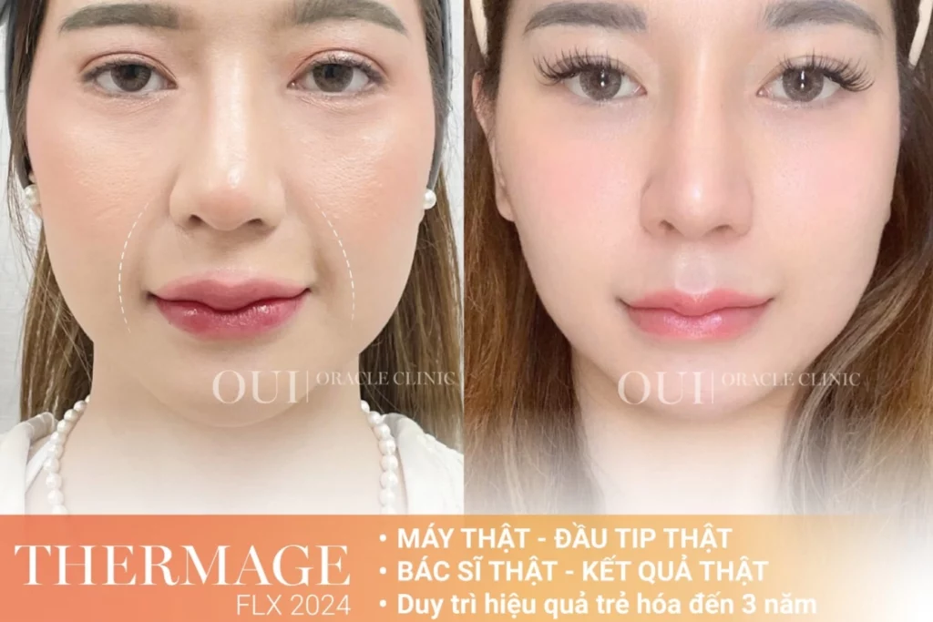 Thermage FLX có cần làm lại không?