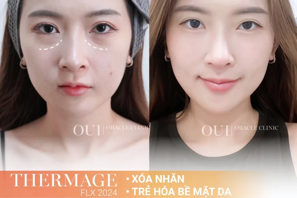Thermage FLX có cần làm lại không?