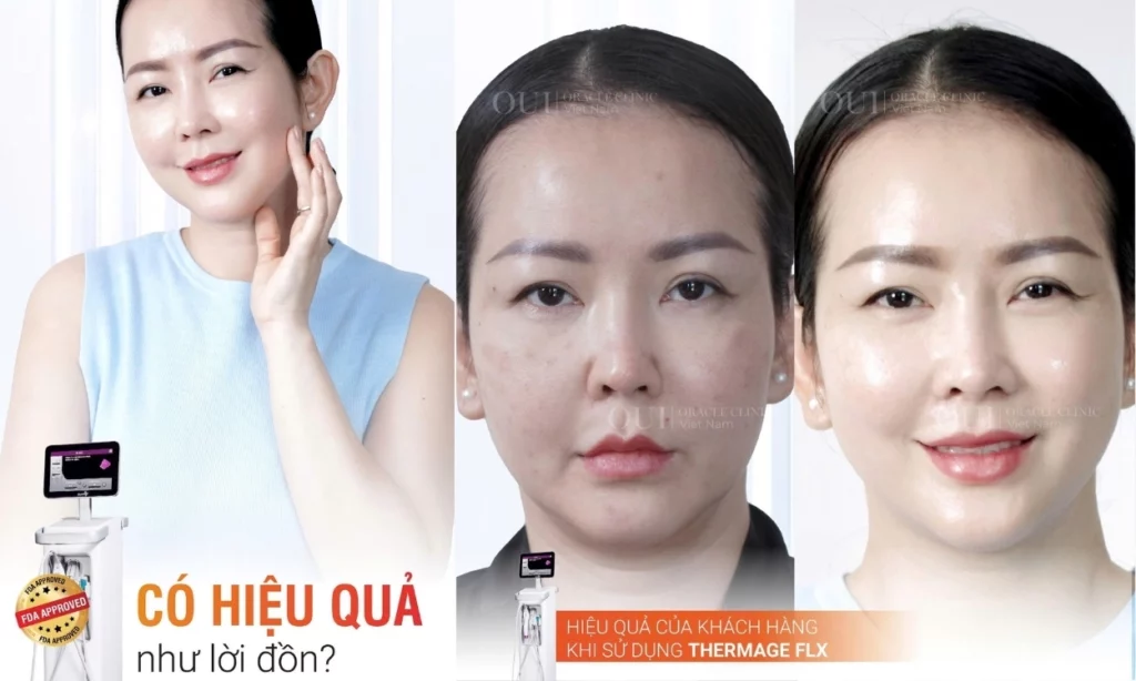 thermage phù hợp với ai