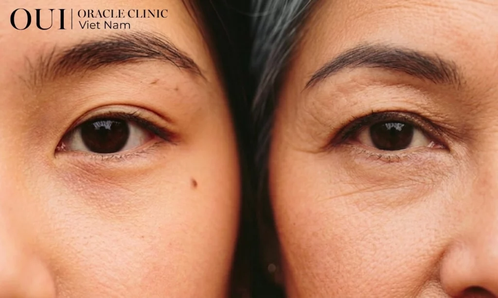 thermage phù hợp với ai