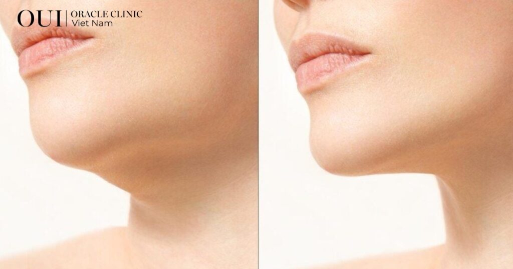 trẻ hóa không nghỉ dưỡng