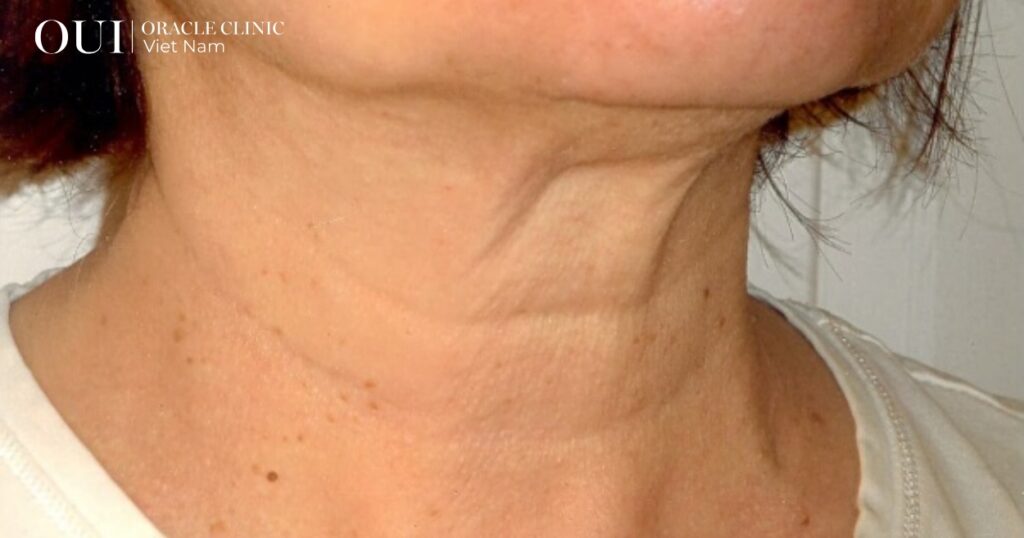 trẻ hóa không nghỉ dưỡng