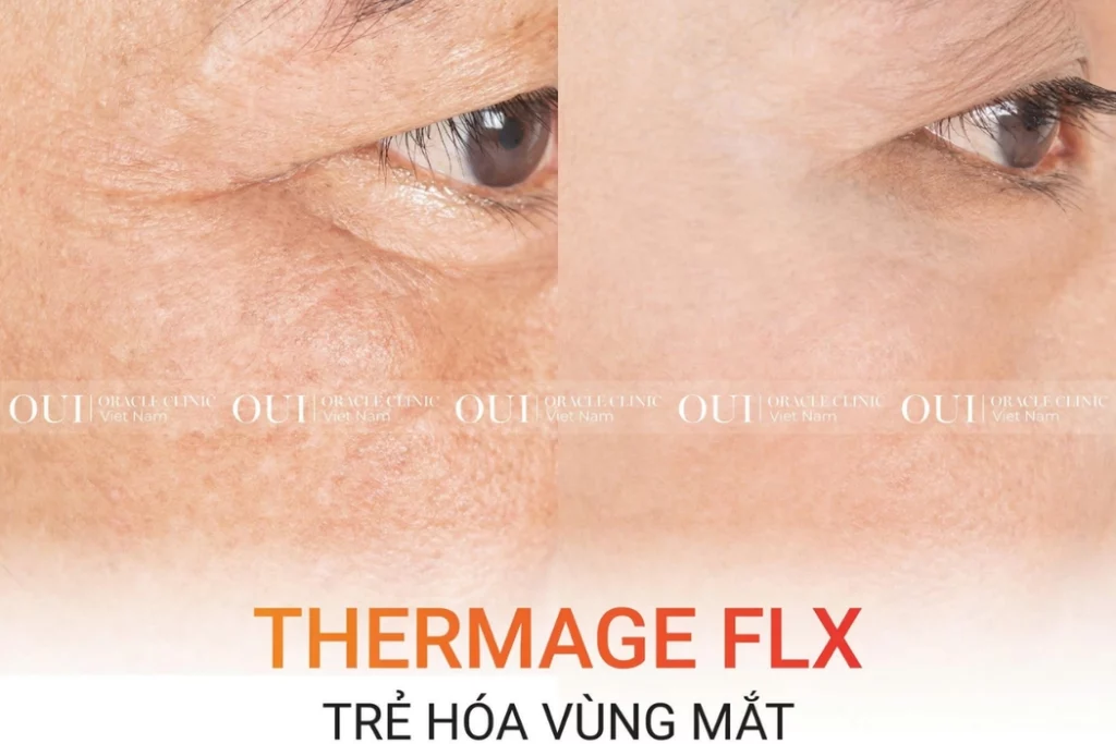 trẻ hóa vùng mắt
