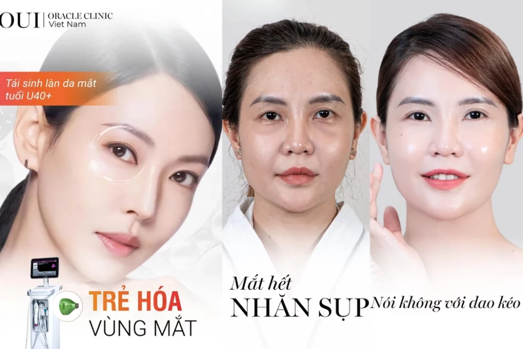 trẻ hóa vùng mắt