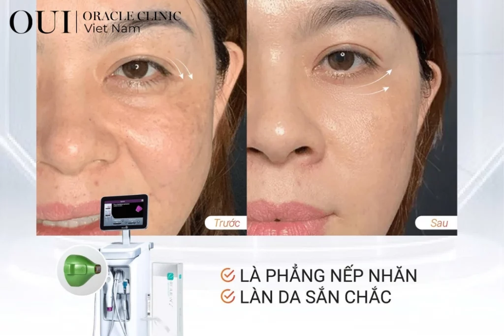 trẻ hóa vùng mắt