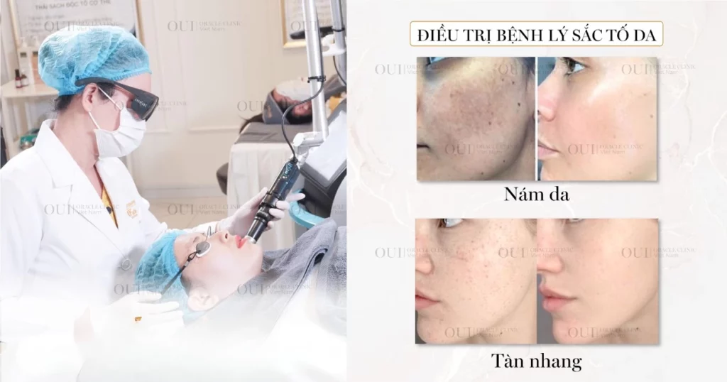 trị nám chuẩn y khoa
