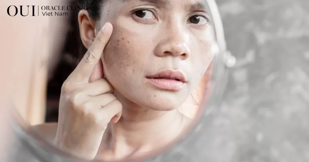 trị nám chuẩn y khoa