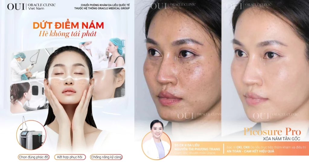 trị nám không bong tróc