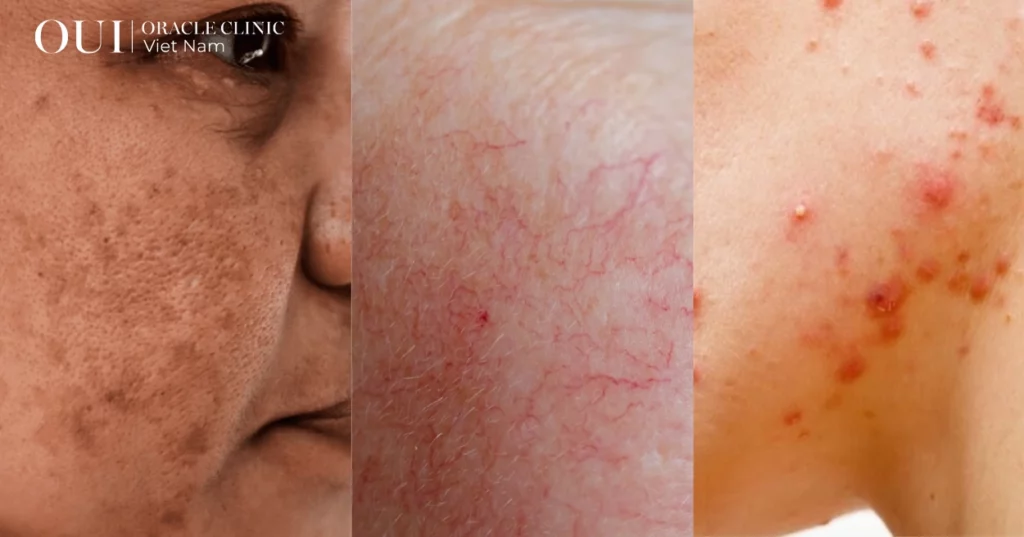 trị nám không bong tróc