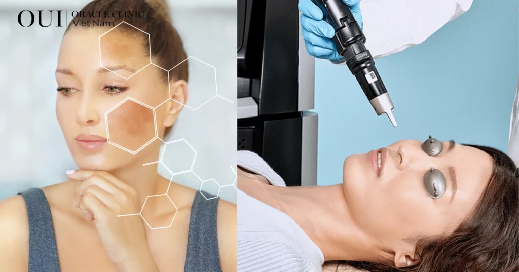 trị nám không bong tróc với tiêu chí 3 không