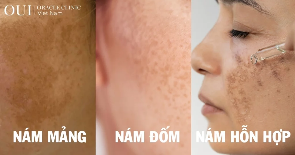 trị nám sau sinh