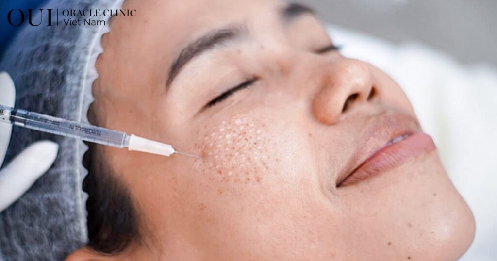 trị nám sau sinh