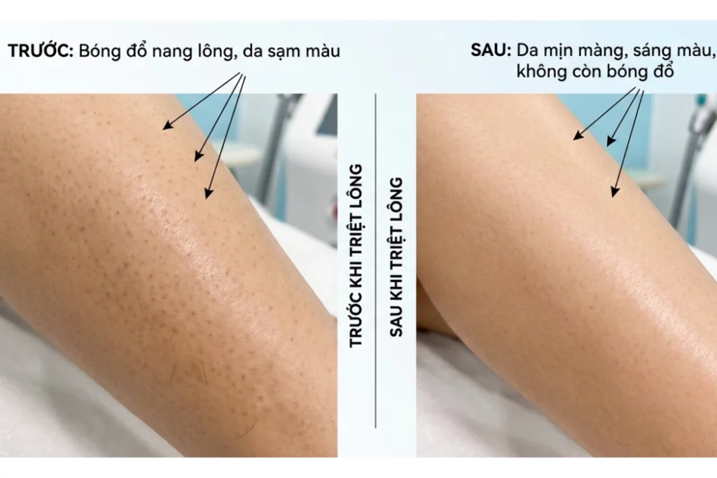 triệt lông chuẩn y khoa