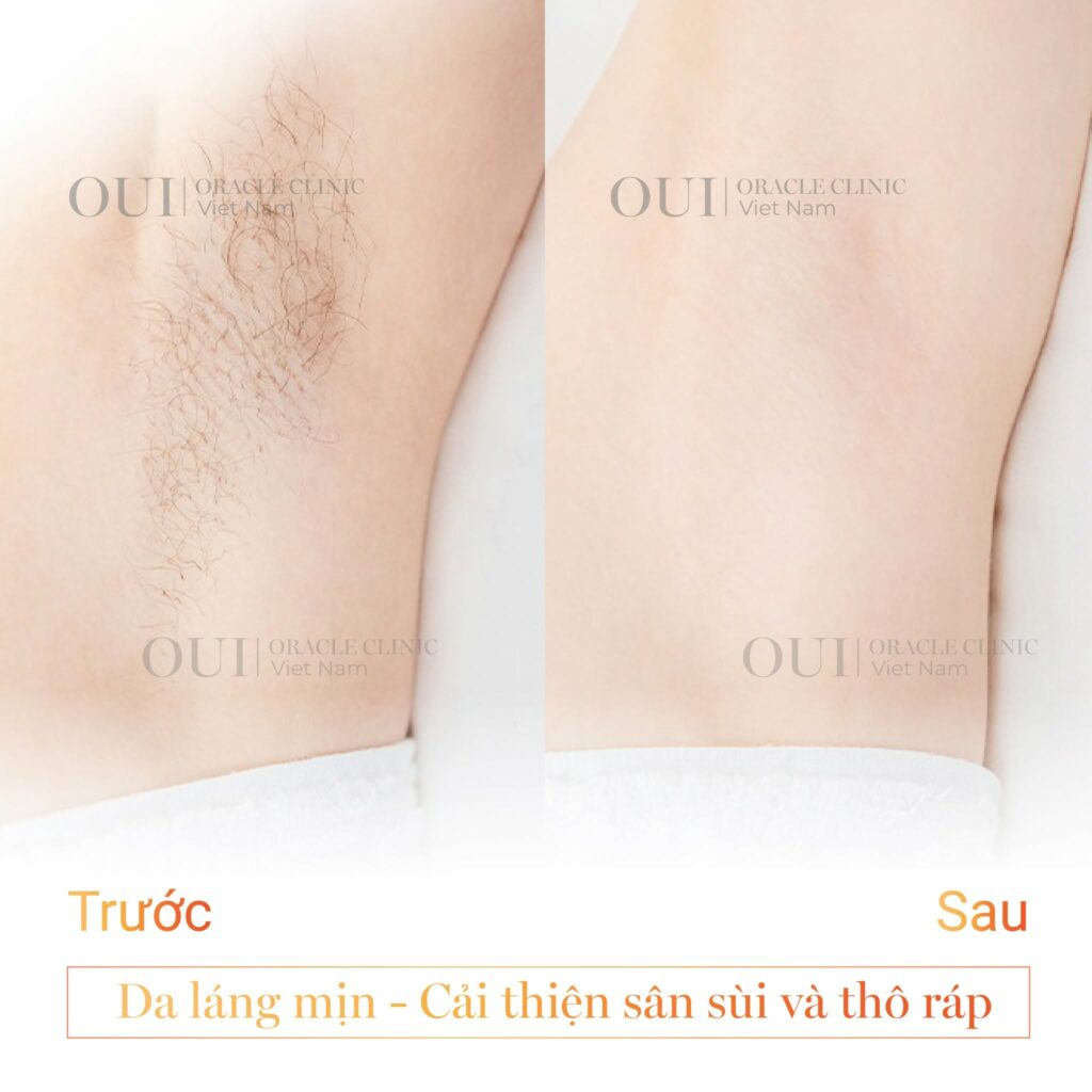 triệt lông có giúp da đều màu hơn không?