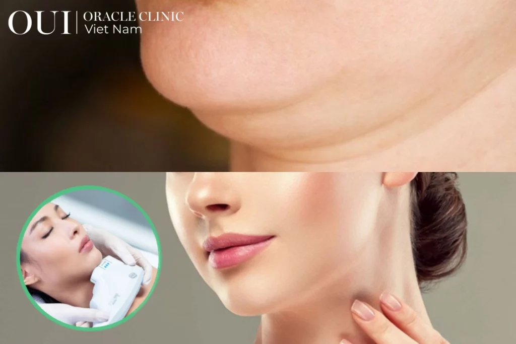 ultherapy có giảm nọng cằm không