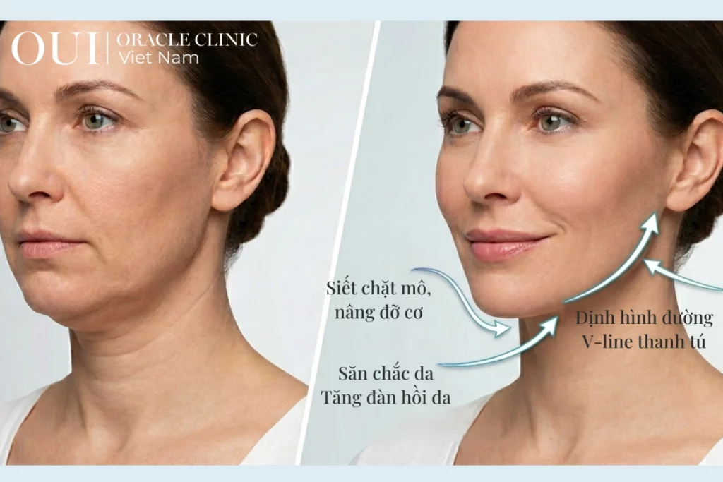 ultherapy có giảm nọng cằm không