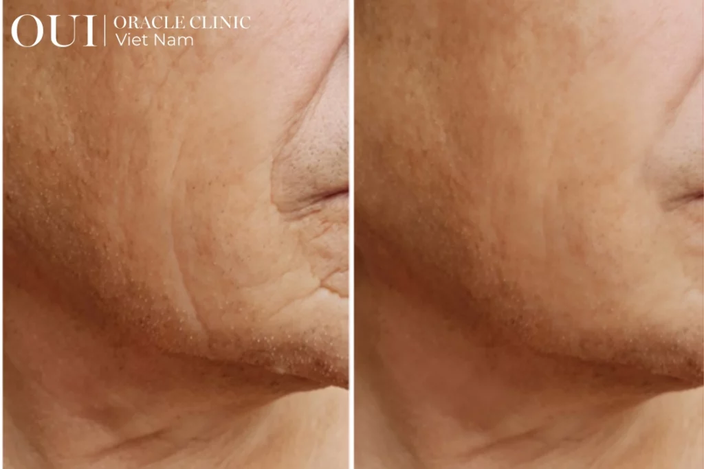 ultherapy có giảm nọng cằm không