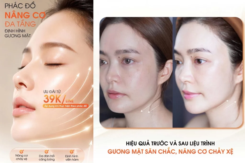 Ultherapy toàn mặt