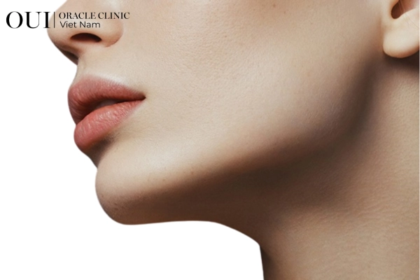 Ultherapy toàn mặt