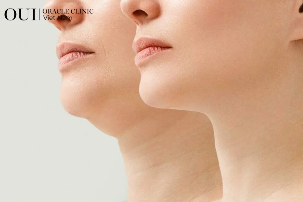 Ultherapy toàn mặt