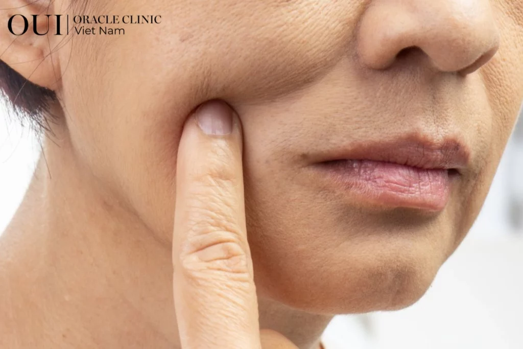 Ultherapy toàn mặt