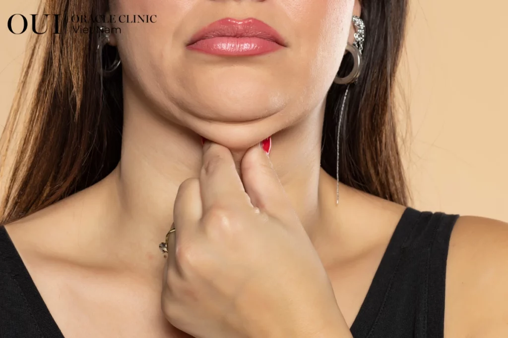 Ultherapy toàn mặt